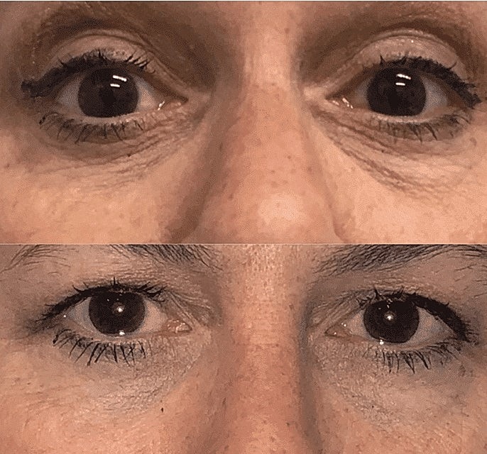 Under Eye Fillers: A Non-Surgical Option for Eye Bag Reduction - Image 5