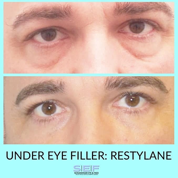 Under Eye Fillers: A Non-Surgical Option for Eye Bag Reduction - Image 3