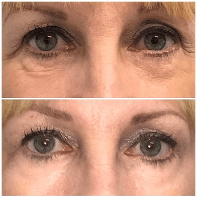 Under Eye Fillers: A Non-Surgical Option for Eye Bag Reduction - Image 4