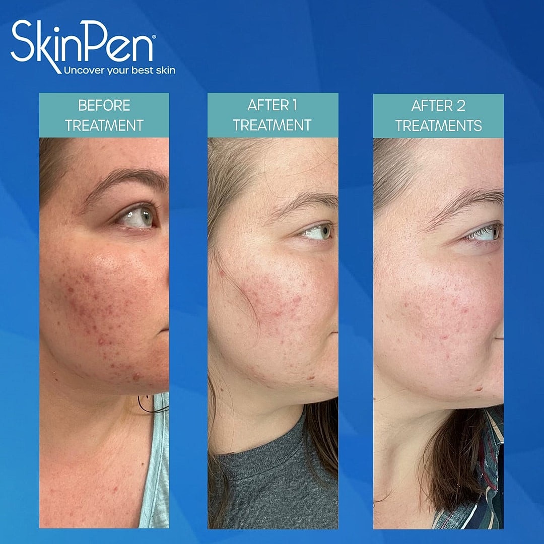Unleash Your Skin’s Potential with Safe, Effective SkinPen Treatments - Image 2