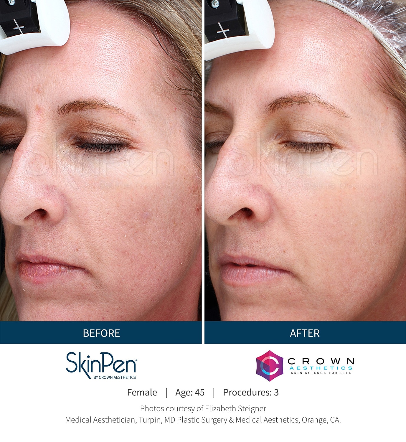 Unleash Your Skin’s Potential with Safe, Effective SkinPen Treatments - Image 3