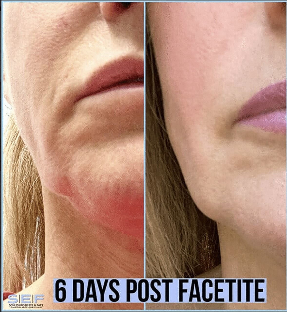 Who Is a Good Candidate for Facetite? - Image 2
