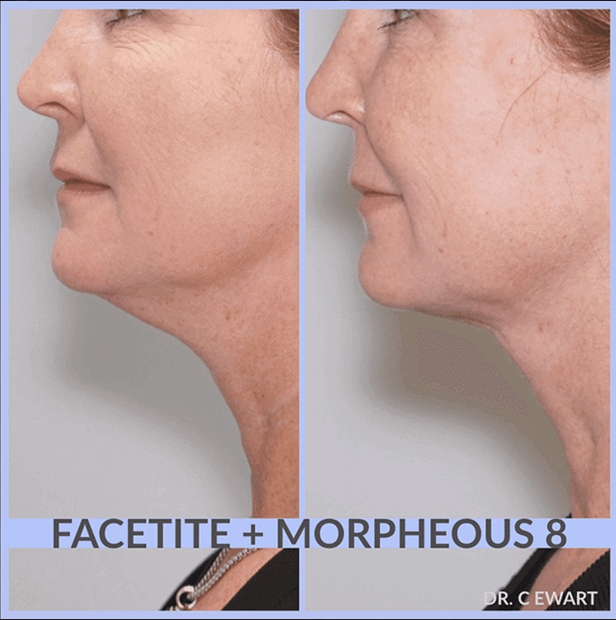 Who Is a Good Candidate for Facetite? - Image 3