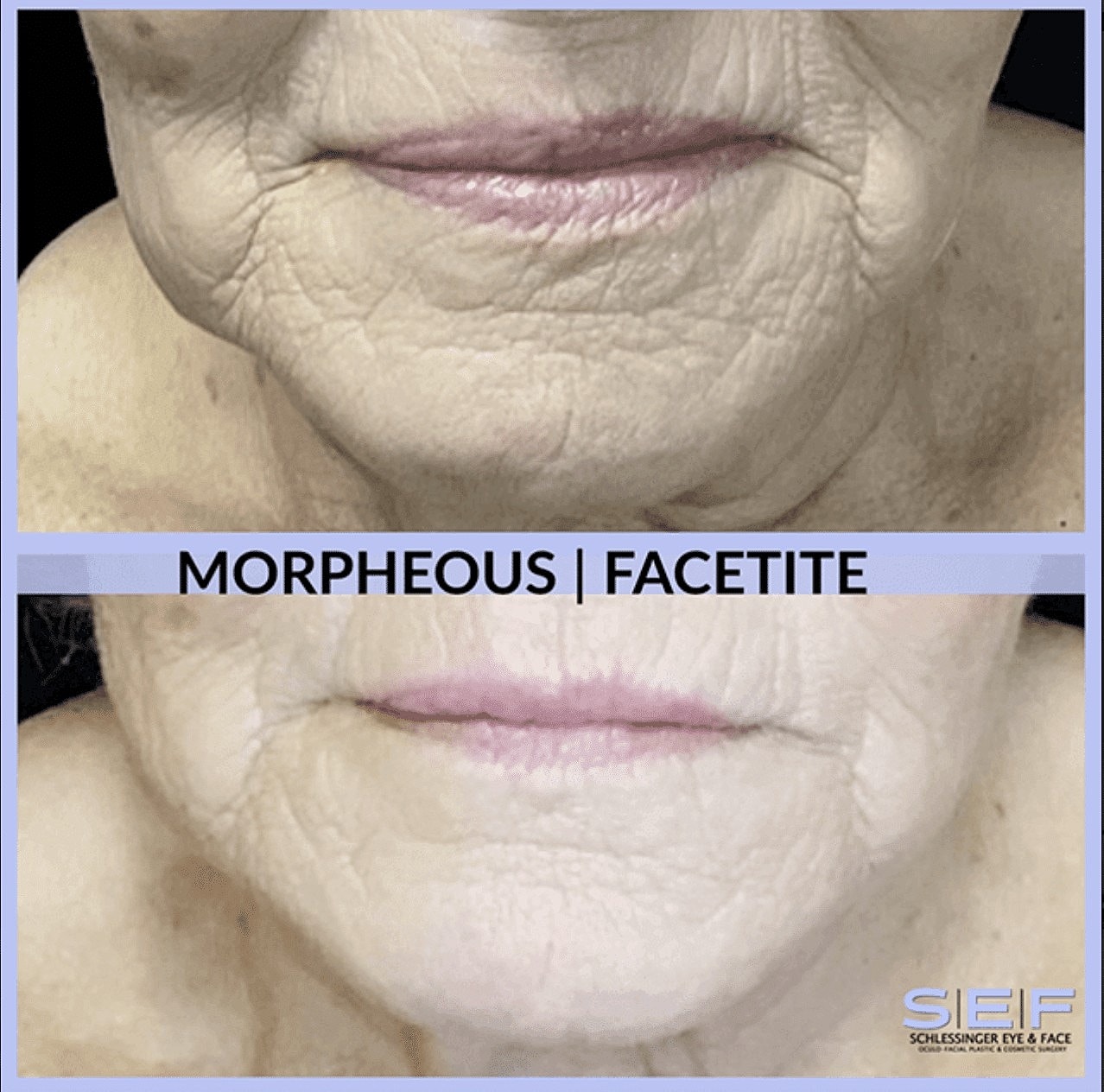 Who Is a Good Candidate for Facetite? - Image 4