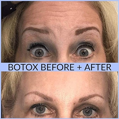 Who Is An Ideal Candidate for Botox? - Image 2