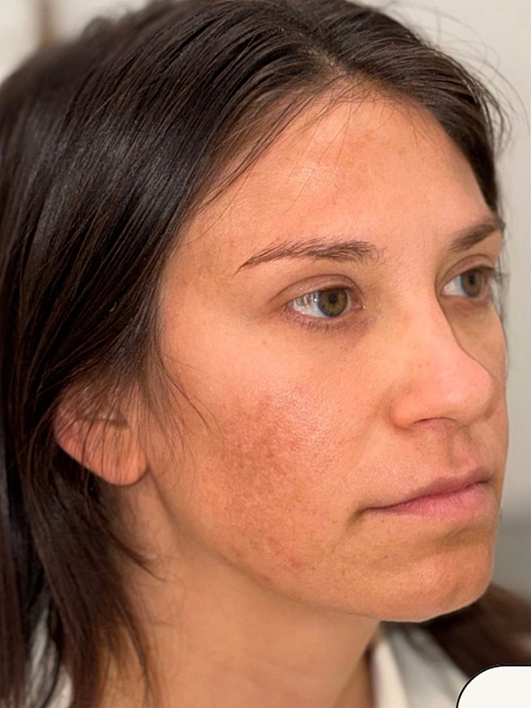 Before Treatment