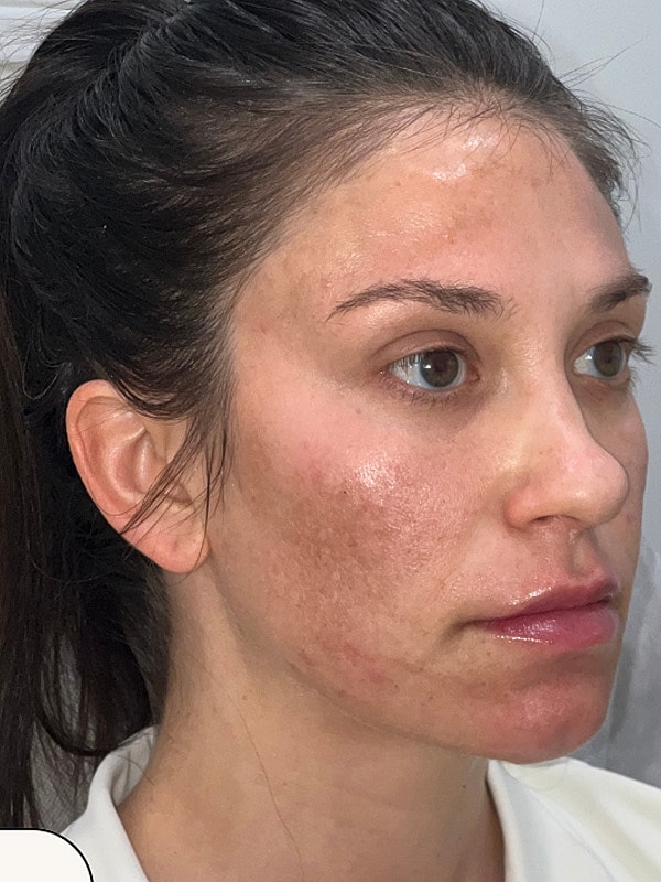 After Treatment