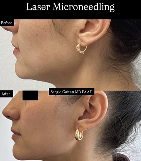 Before and after laser microneedling skin tightening results