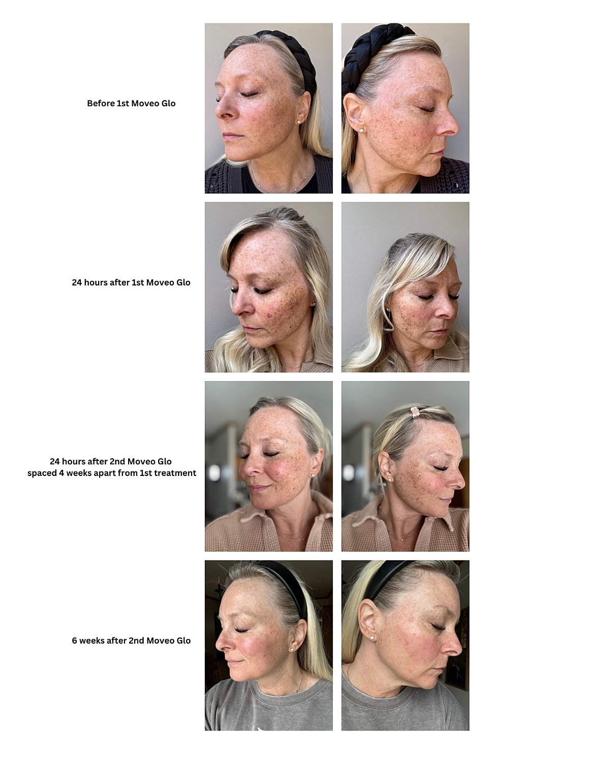 Before and after Moveo Glo treatments progress.