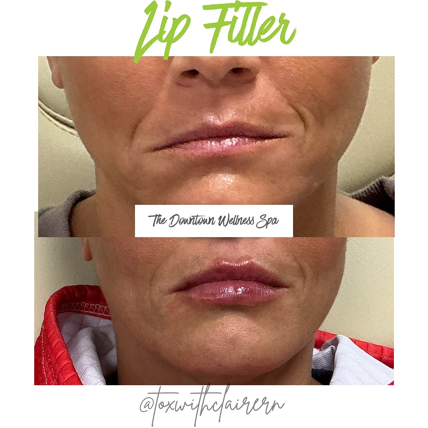 Lip filler before and after comparison image.