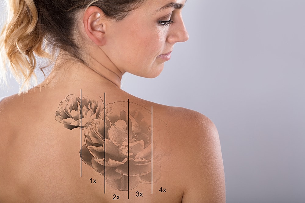 Laser tattoo removal treatment on forearm