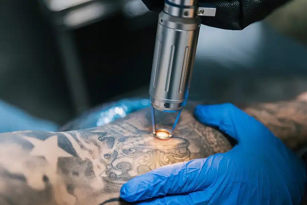 Laser tattoo removal handpiece on shoulder tattoo
