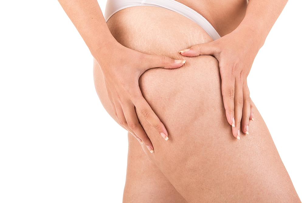 Close-up of smooth thighs after cellulite treatment