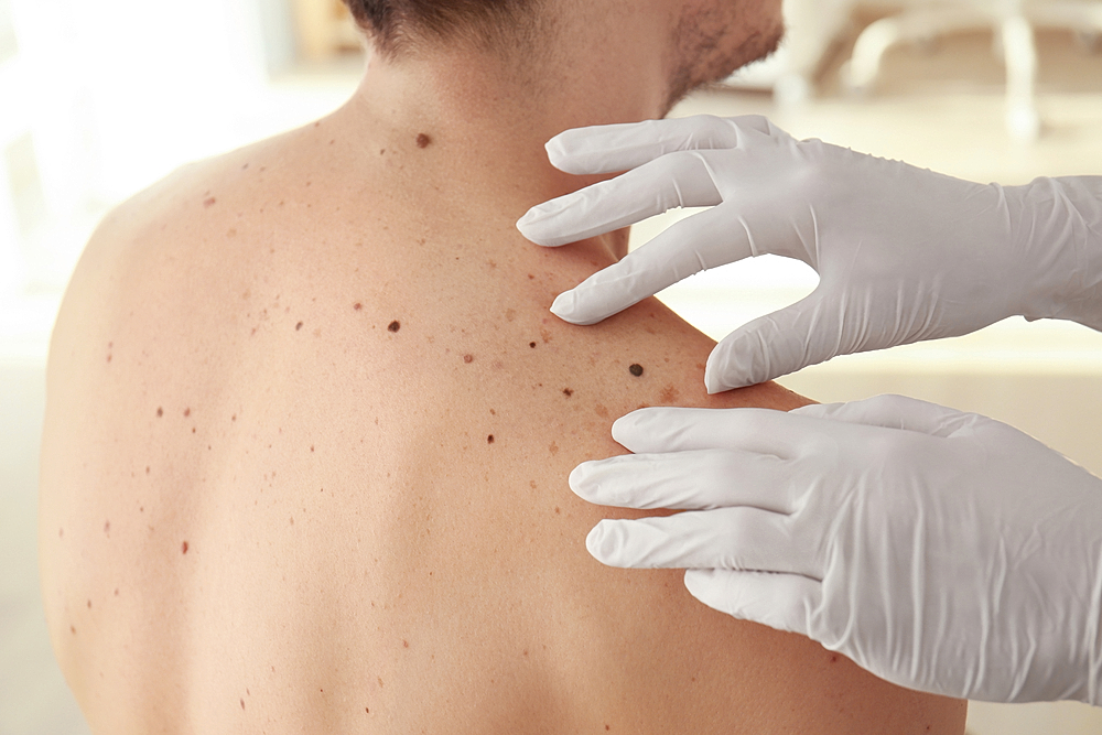patient receiving laser mole removal on cheek