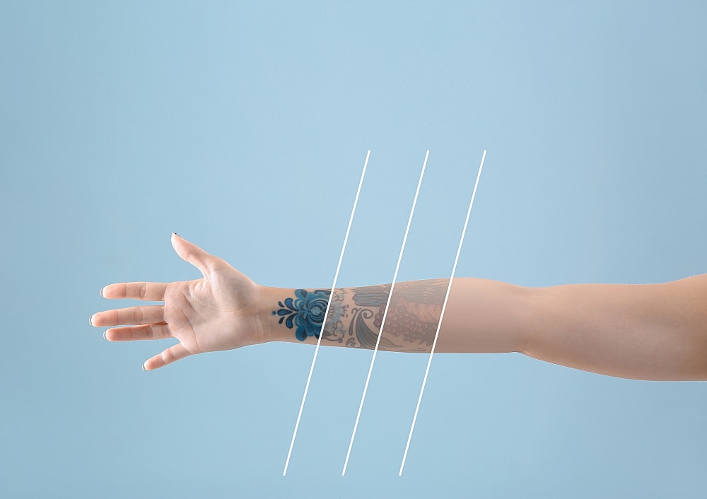 Laser tattoo removal on a forearm in clinic