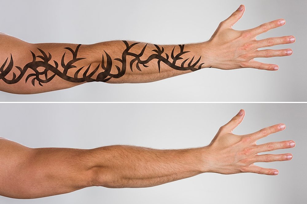 laser tattoo removal specialist treating forearm tattoo