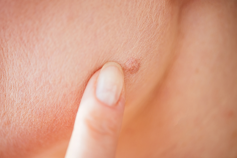 dermatology provider examining mole on shoulder
