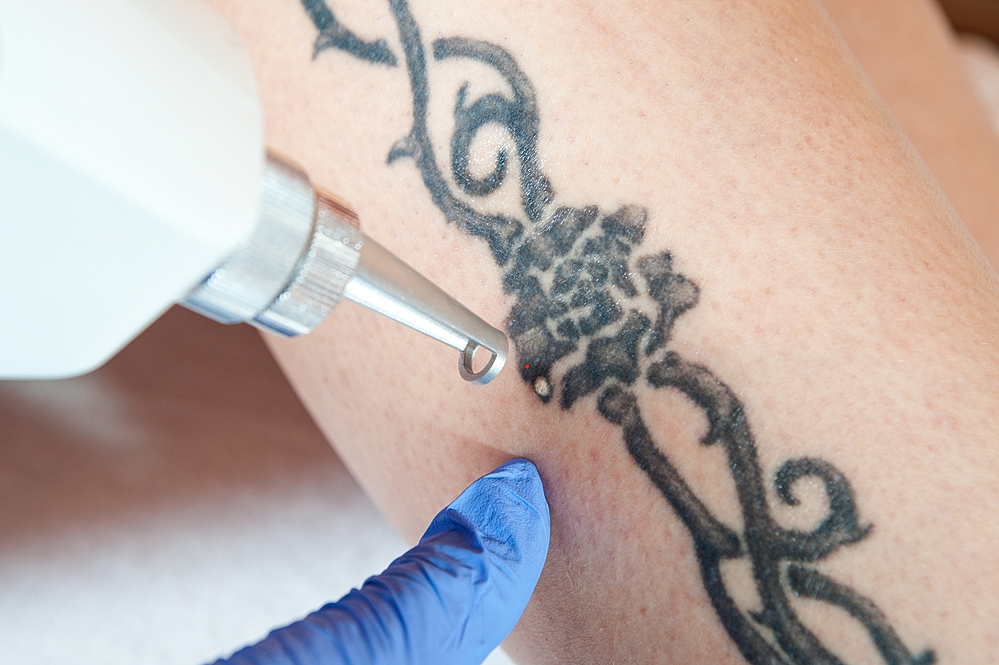 laser tattoo removal device treating arm