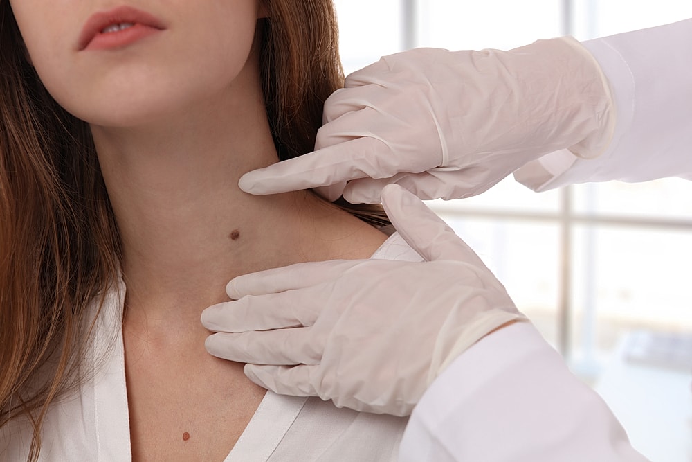 Mole Removal