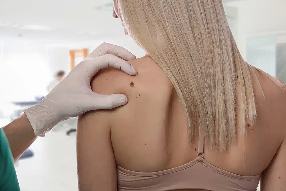 doctor examining mole before laser removal
