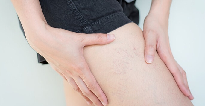 clinician marking leg before sclerotherapy