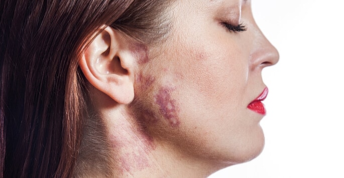 closeup of port wine stain birthmark on cheek
