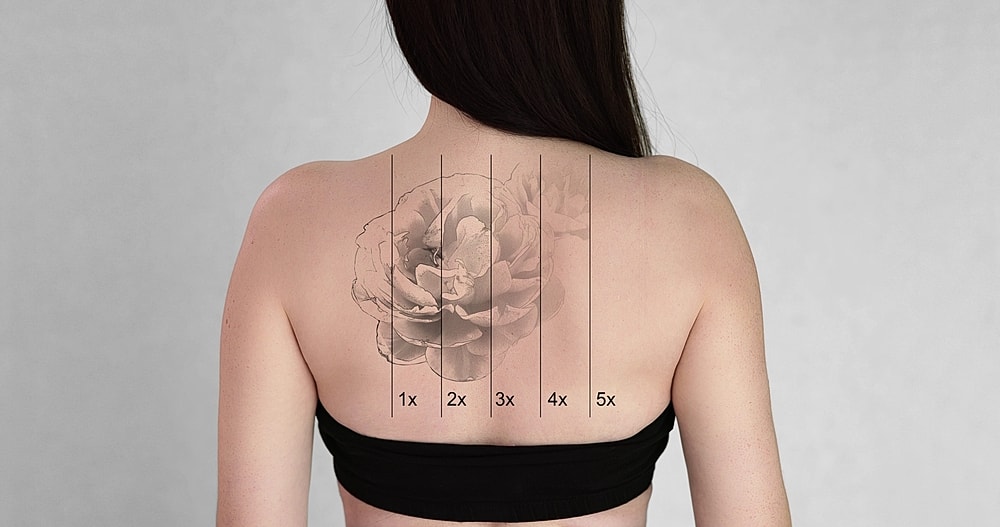 laser tattoo removal targeting forearm design