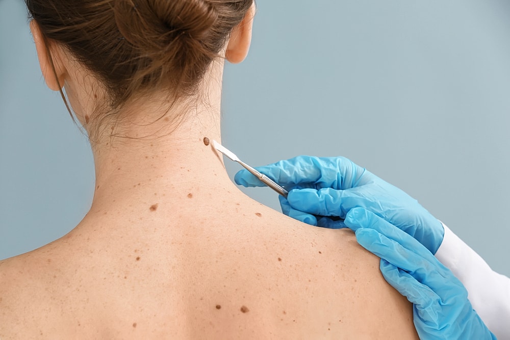 provider examining mole removal site on arm