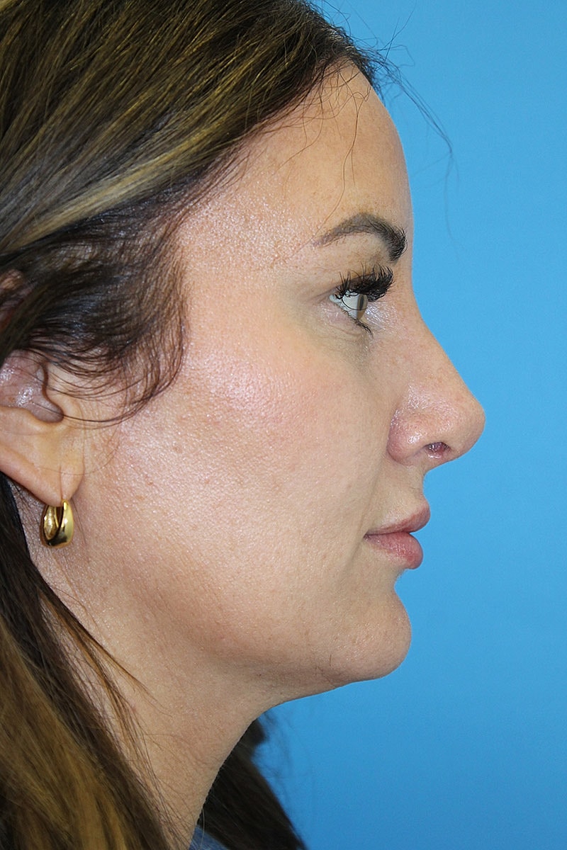 Rhinoplasty Before & After
