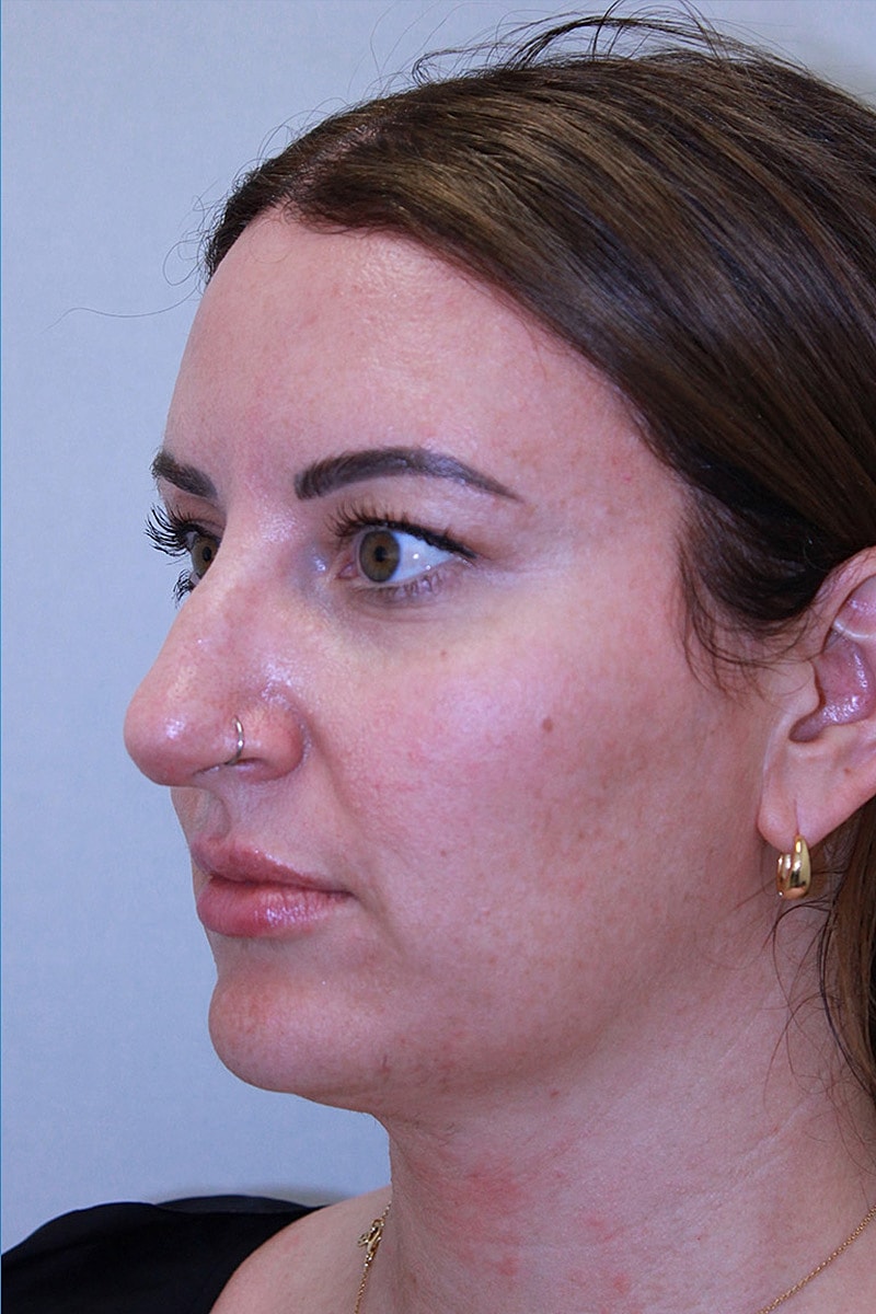 Rhinoplasty Before & After