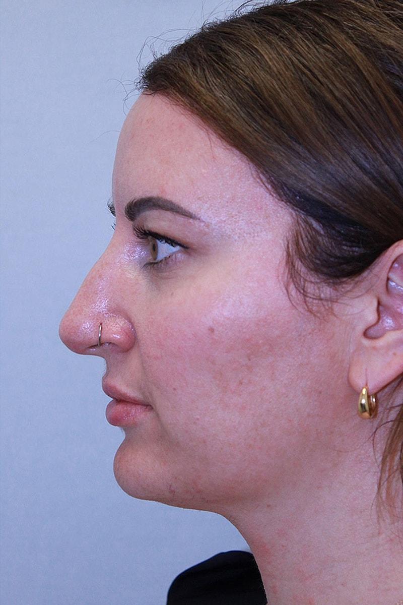 Rhinoplasty Before & After