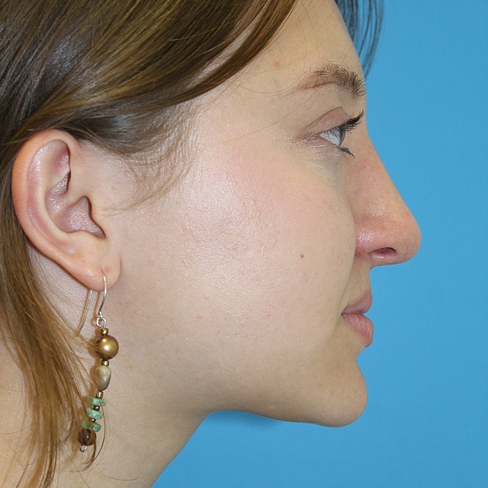 Rhinoplasty Before & After