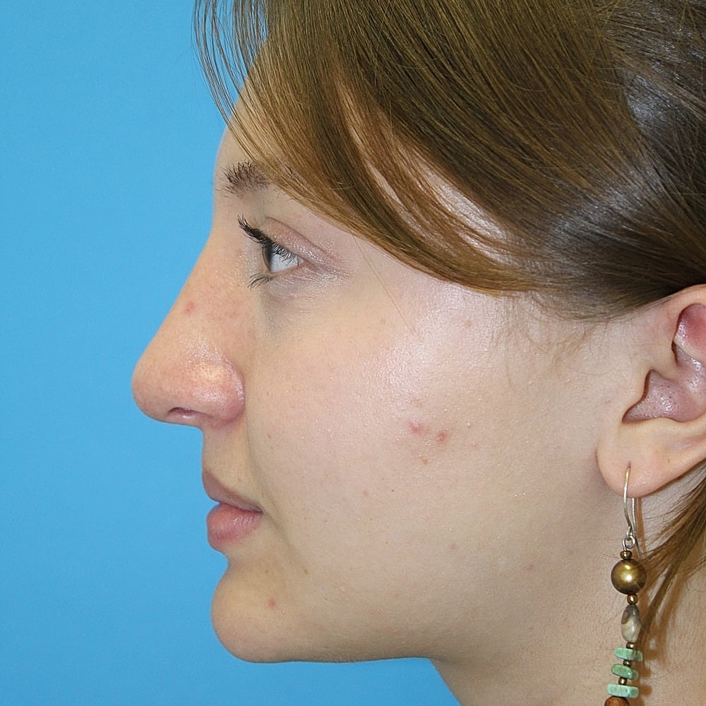Rhinoplasty Before & After