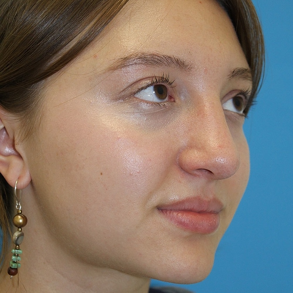 Rhinoplasty Before & After