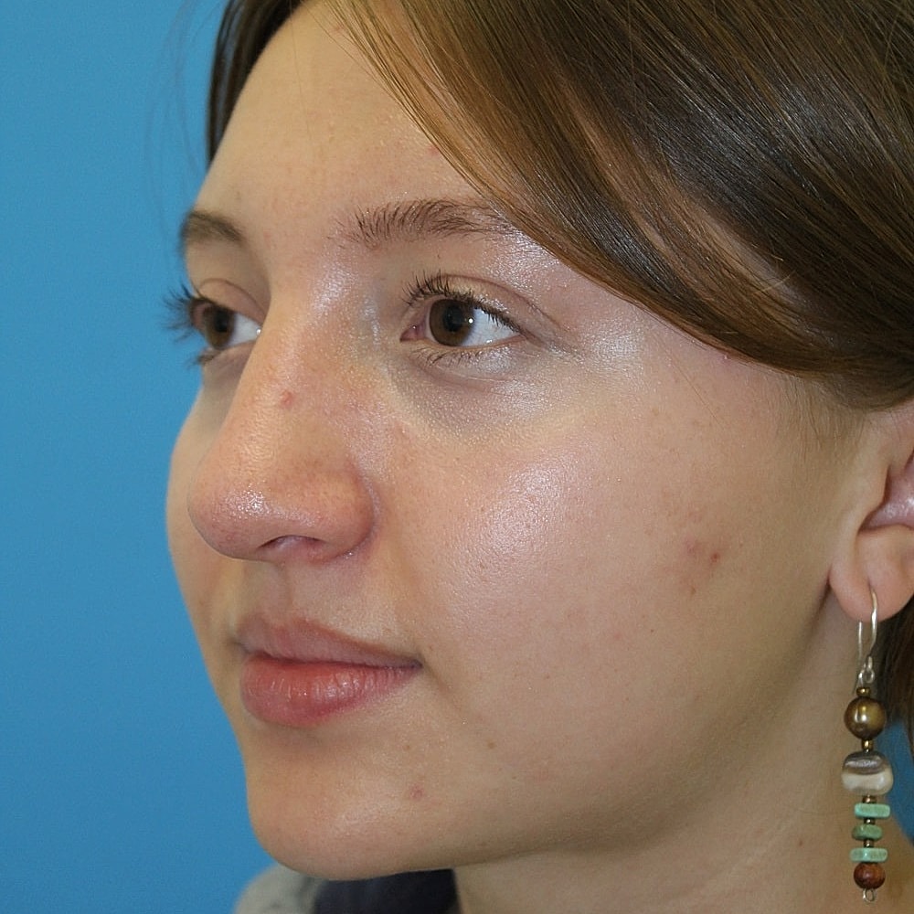 Rhinoplasty Before & After