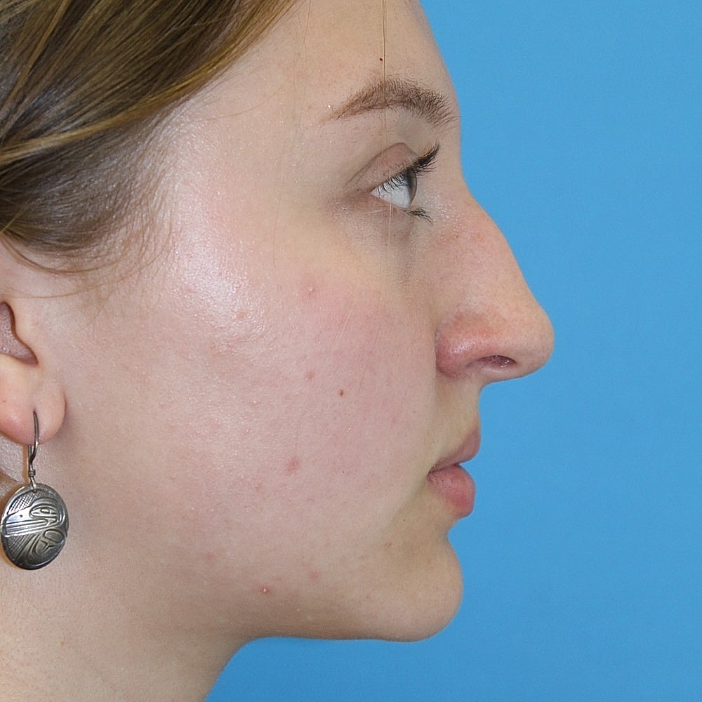 Rhinoplasty Before & After