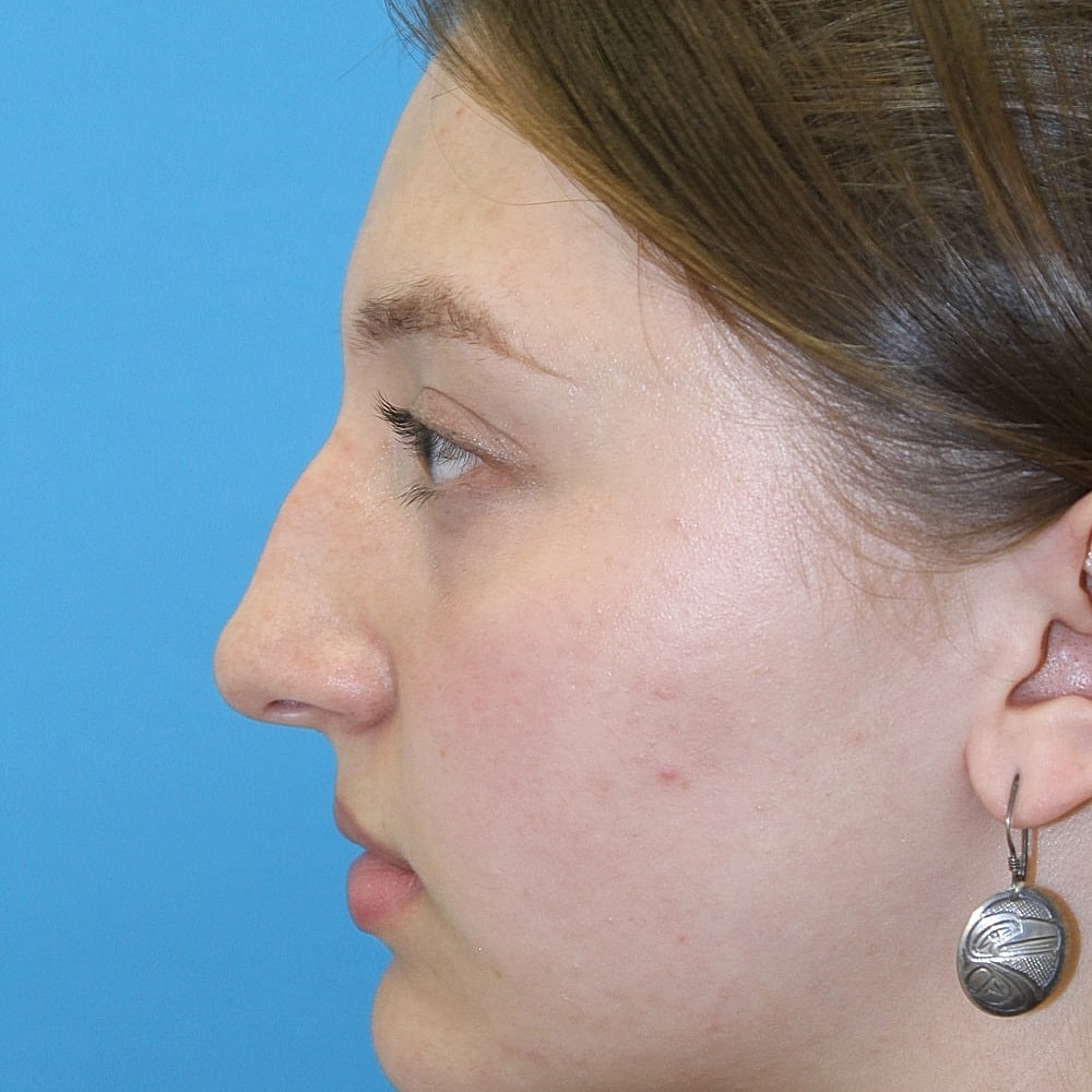 Rhinoplasty Before & After