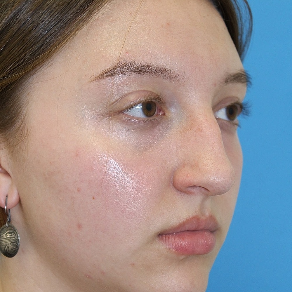 Rhinoplasty Before & After