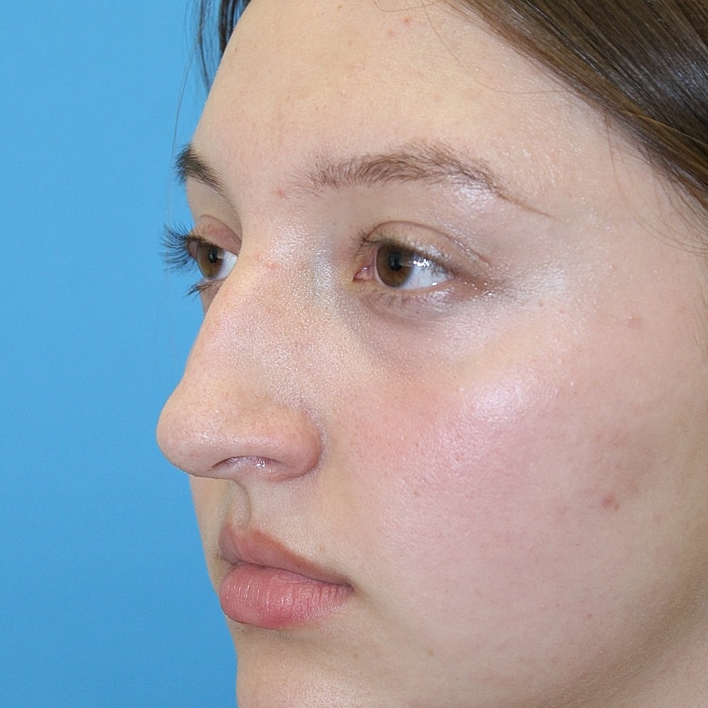 Rhinoplasty Before & After