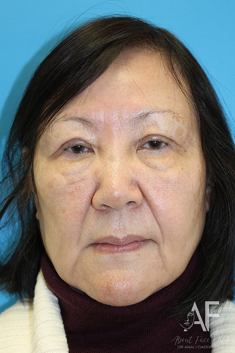 Upper Blepharoplasty Before & After