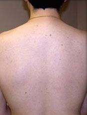 Laser Hair Removal Before & After