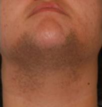 Laser Hair Removal Before & After