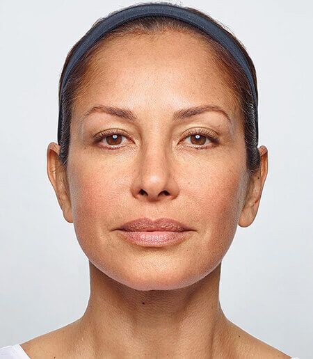 Dysport® Before & After