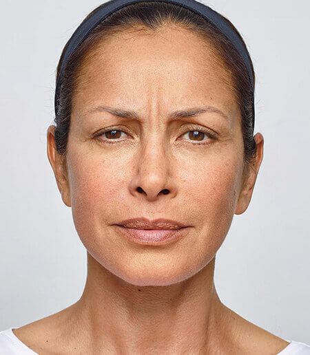 Dysport® Before & After