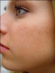 Clear Complexion Facial Before & After