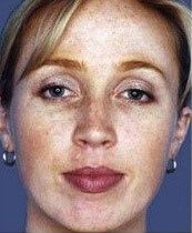 Deep Chemical Peel Before & After
