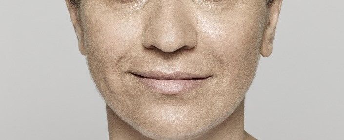 Restylane™ Lyft Before & After