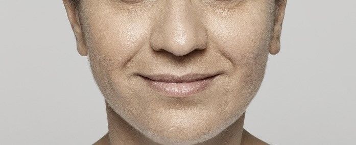 Restylane™ Lyft Before & After