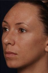 Vitalize Peel Before & After