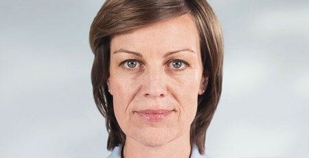Sculptra® Before & After